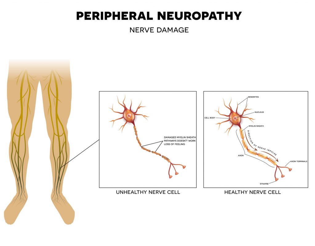 peripheral neuropathy