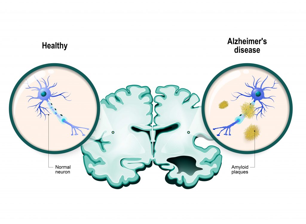 Alzheimer's brain