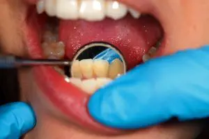 brushing and grinding your teeth removes plaque, how to remove plaque from teeth, plaque removal, plaque removal at home, plaque remover, how to remove plaque on teeth, tartar on teeth, black tartar on teeth, tartar buildup on teeth, what is tartar on teeth, biofilm, biofilms, what is biofilm, biofilm in mouth